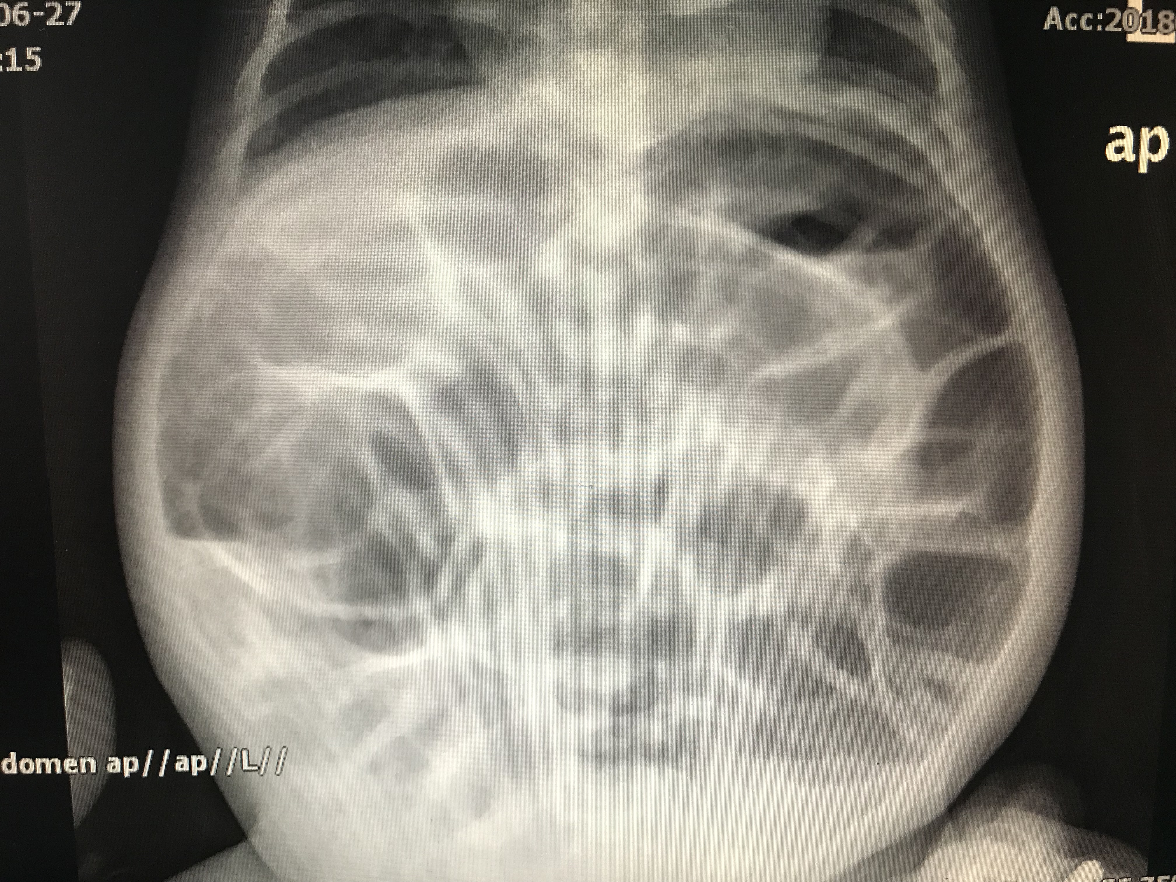 宝宝腹胀如鼓,儿童结肠胀气的症状及治疗