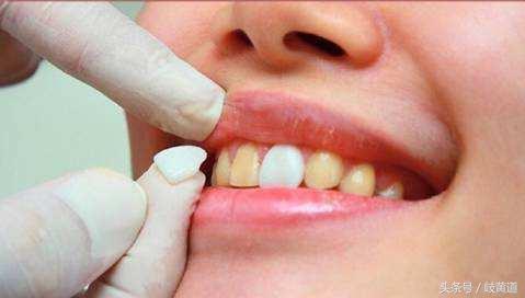 牙老是刷不干净有牙垢怎么回事,牙特别黄怎么刷都刷不白