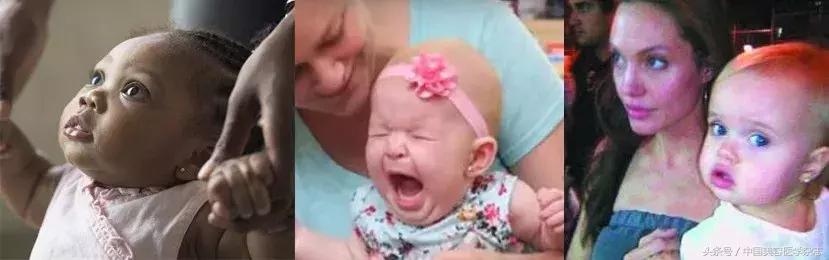 手术联合放疗治疗瘢痕疙瘩,耳廓瘢痕疙瘩切除手术后耳朵化脓