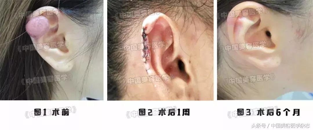 手术联合放疗治疗瘢痕疙瘩,耳廓瘢痕疙瘩切除手术后耳朵化脓