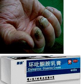 治疗真菌感染皮肤病中药外用,真菌感染皮肤药膏大全