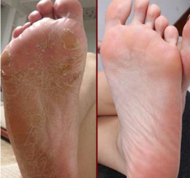 擦掉一张皮，双脚换皮术！死皮、老茧一喷就没，15秒还原嫩白玉足！