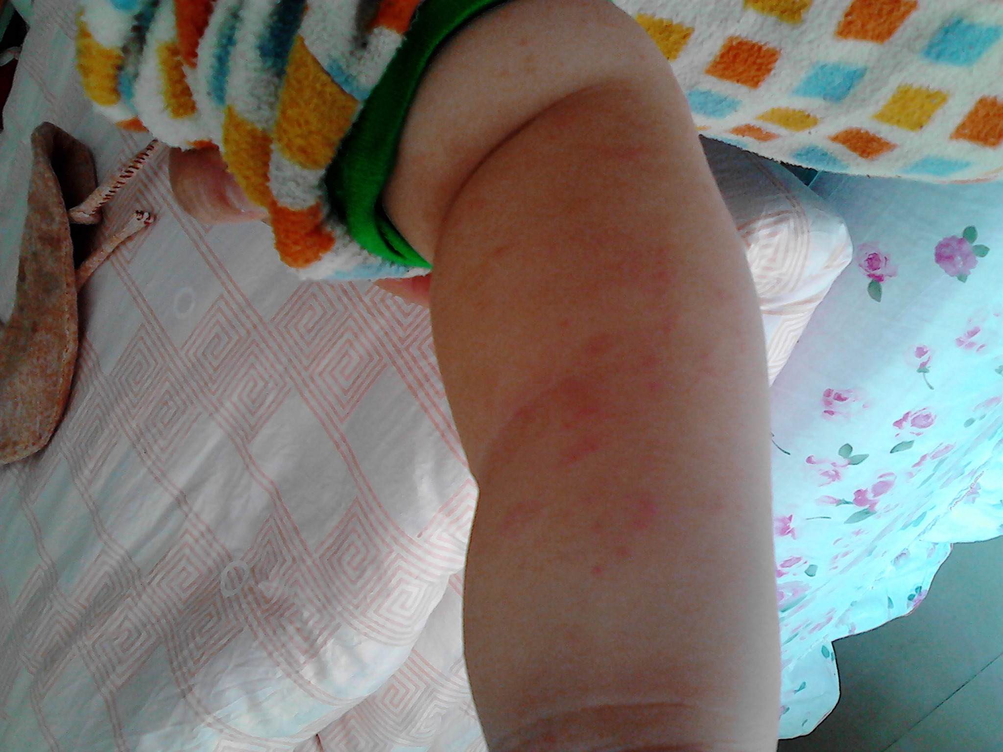 容易长湿疹教你3个方法赶走湿疹,宝宝湿疹快速消除小窍门