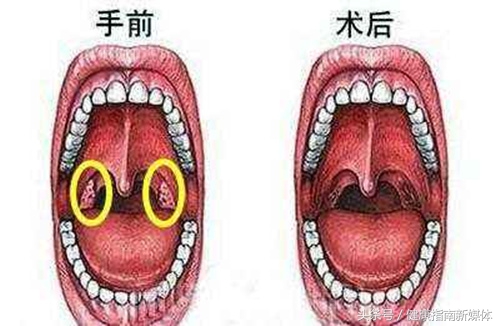 7岁小孩扁桃体肿大要切除吗,扁桃体2到3度肿大需要切除吗