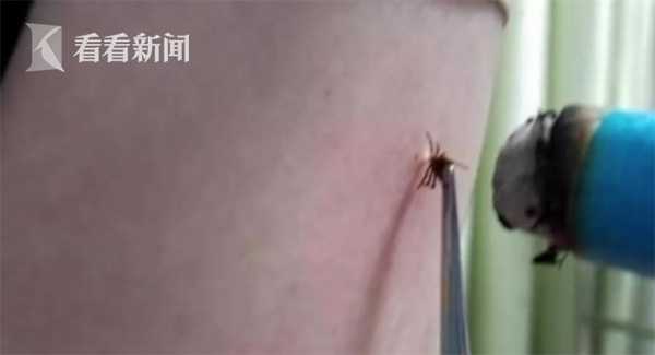 夺命蜱虫,蜱虫咬人一家几口死亡事件
