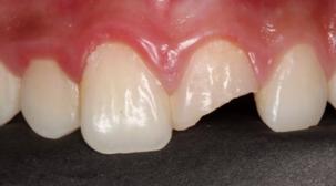 怎么拯救牙齿最快最有效,如何拯救牙齿