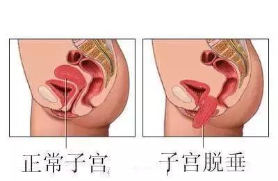 29岁女士竟然尿湿裤子，专家说我国有三成女性患有此病！