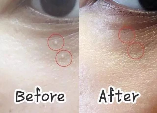 不用针挑手指扎进刺了怎么办,不用针挑就能挑出刺的方法