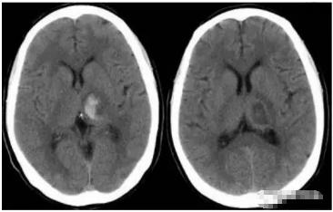 脑出血分期及影像学表现,脑出血各个部位的临床表现