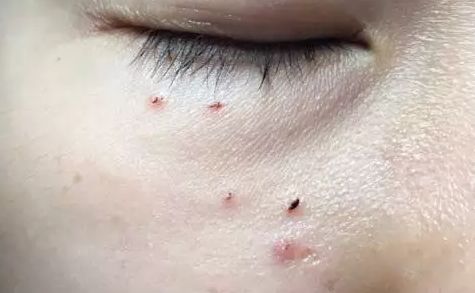 不用针挑手指扎进刺了怎么办,不用针挑就能挑出刺的方法