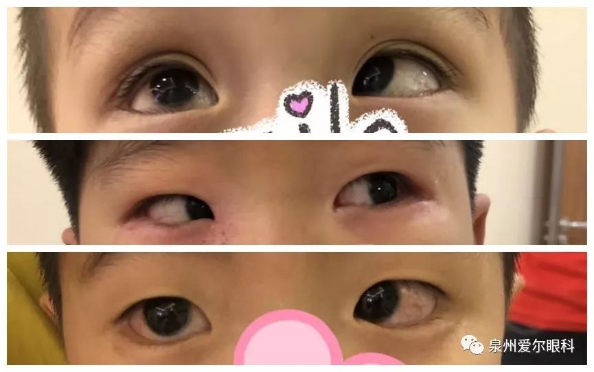 世界过敏性疾病日——全面了解过敏性结膜炎