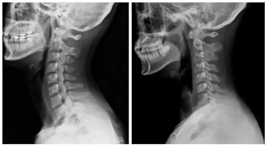 颈椎生理曲度变直可以针灸吗,颈椎生理曲度变直还能恢复吗