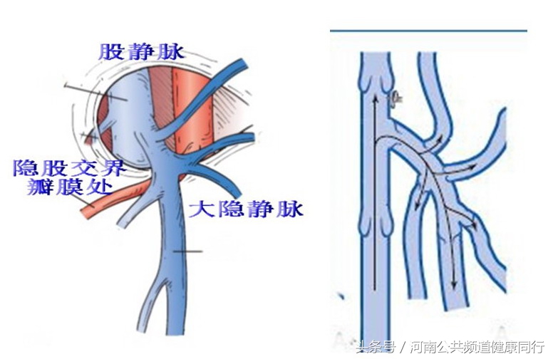 静脉曲张郑大一附院看哪个科,郑大一附院硬化剂治疗静脉曲张