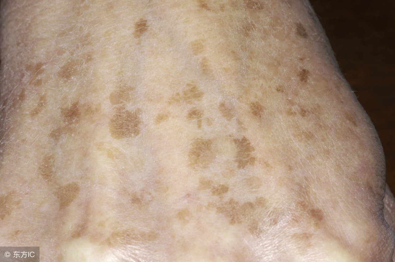 中年人有老年斑怎么预防,老年斑严重的怎么办