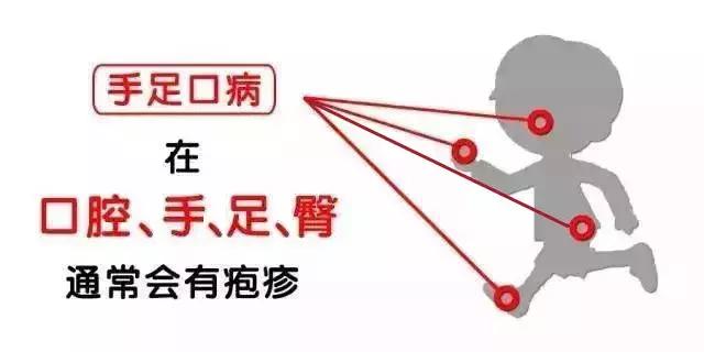 手足口病跟妈妈分离,手足口和疱疹性咽峡炎怎么区别