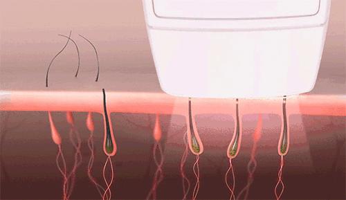 脱毛神器有哪些平价的好用,比较推荐的脱毛神器有哪些