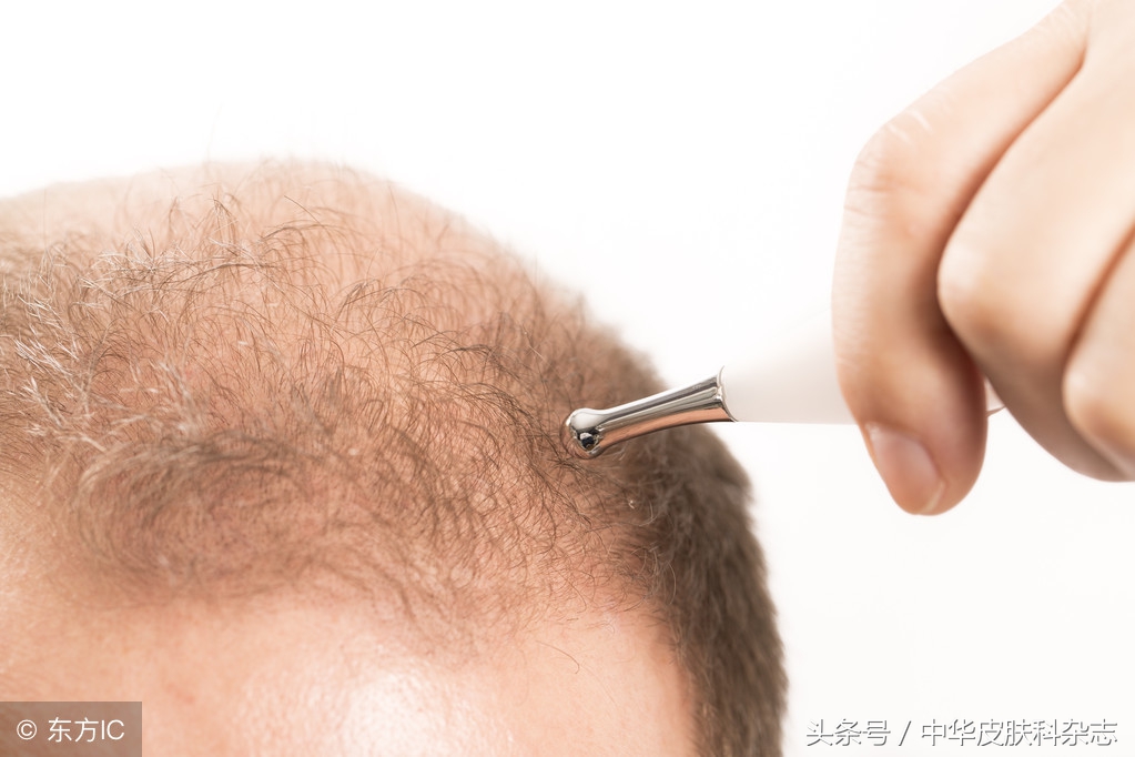 毛发毛囊移植有前景吗,毛发种植的效果好吗费用多少