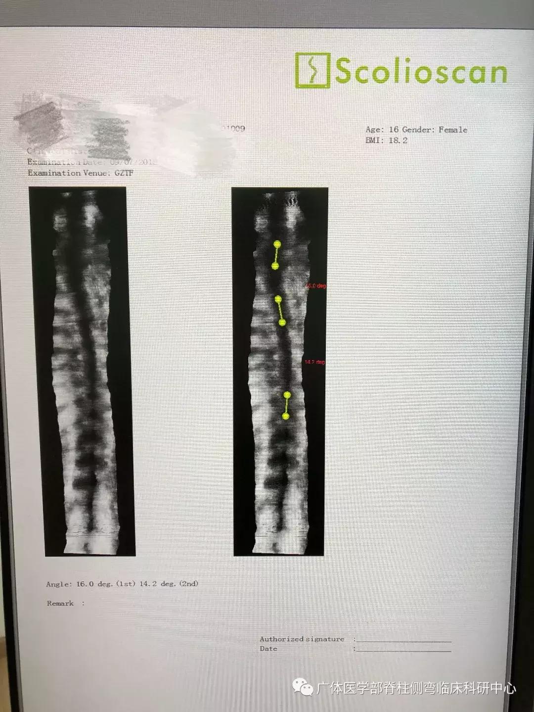 Scolioscan三维超声实现姿势矫正可视化（三）——近胸弯