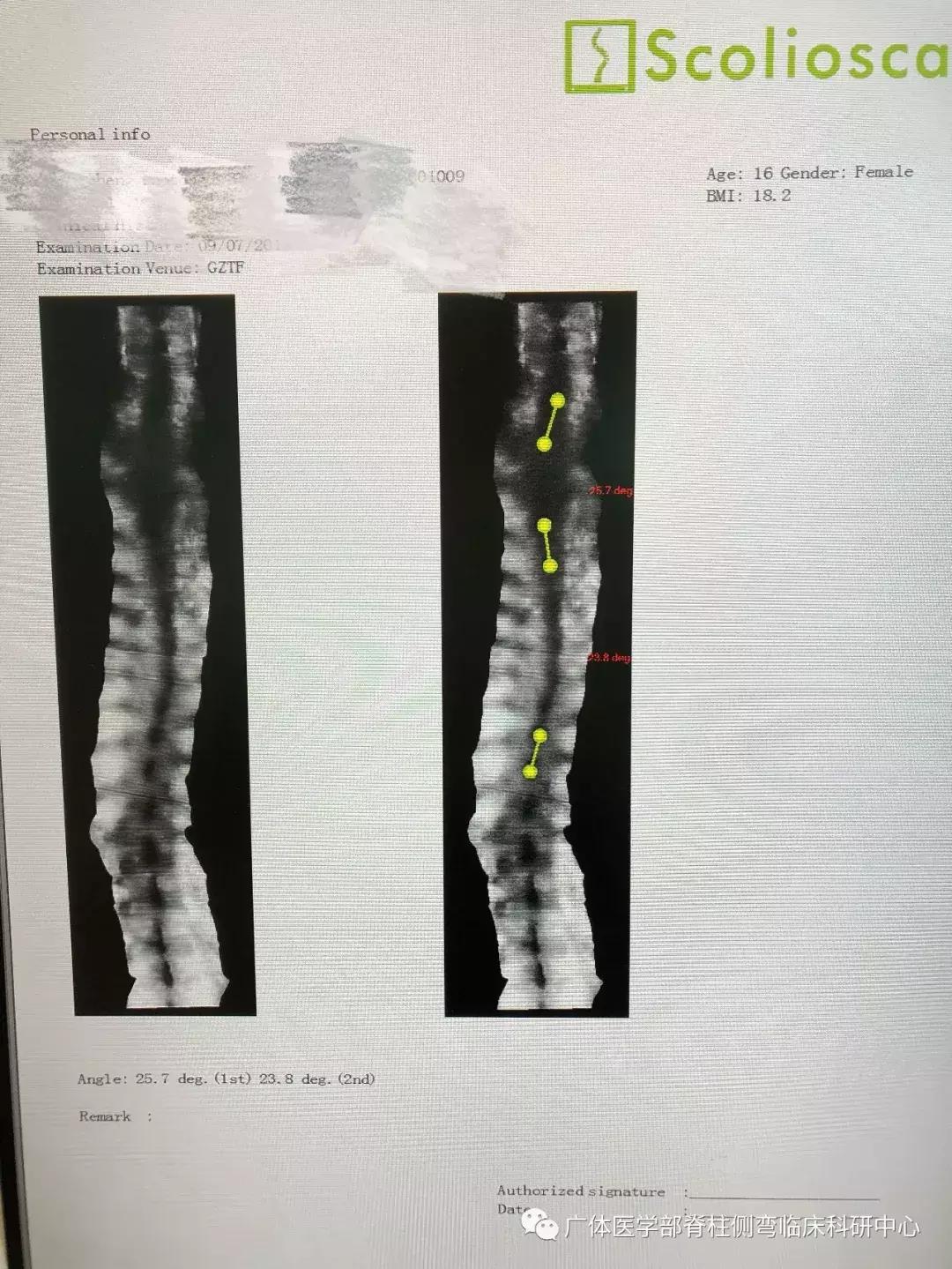 Scolioscan三维超声实现姿势矫正可视化（三）——近胸弯