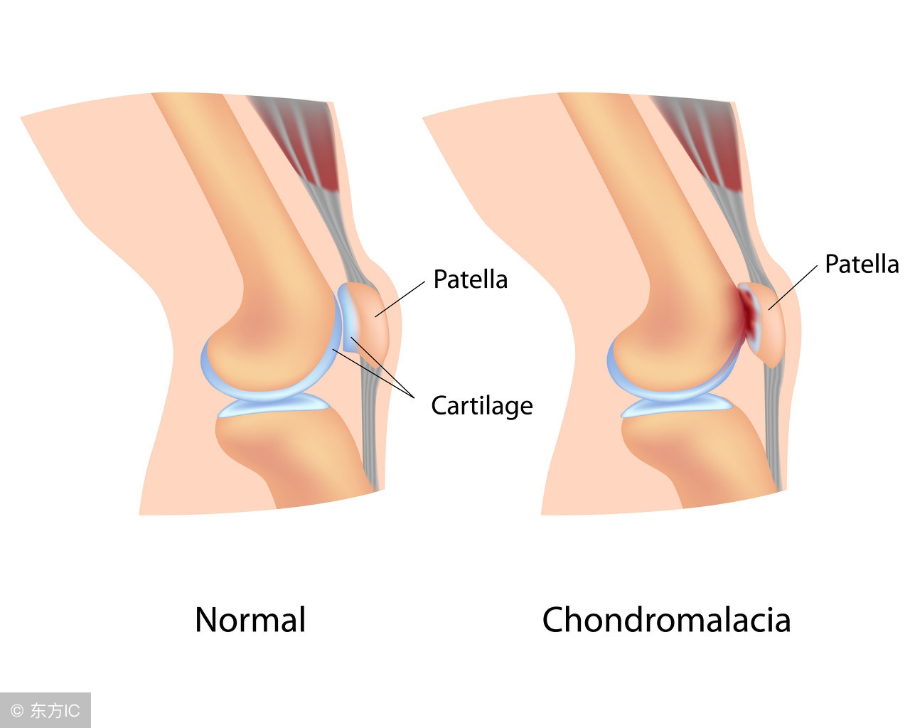 跑步怎么样保护膝盖软骨,跑步膝盖受伤害怎么恢复