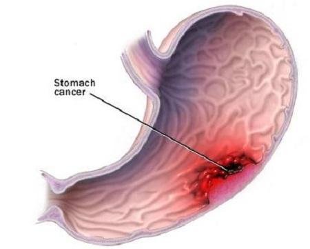 胃炎夏季该怎么预防,夏季胃炎发作