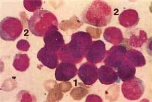 慢性白血病格列卫,慢性粒细胞白血病格列卫
