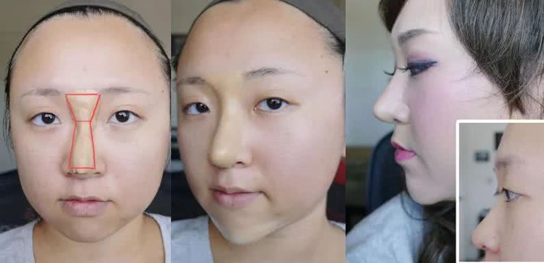 不动手术有哪些隆鼻方法,不动刀的隆鼻好方法