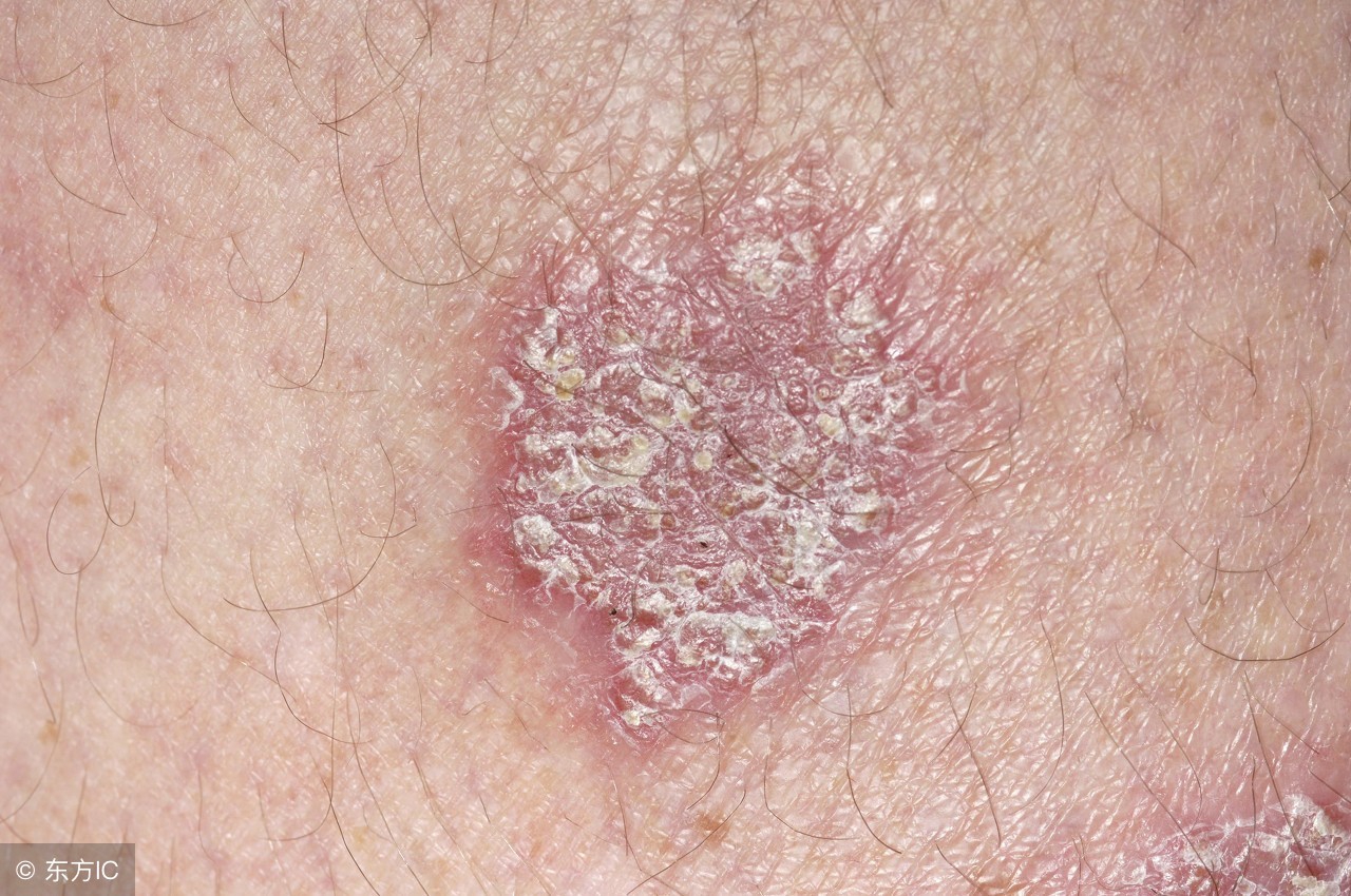 牛皮癣好发于人体哪些部位,隐私部位牛皮癣怎么治疗