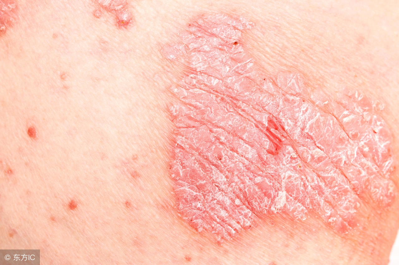 牛皮癣好发于人体哪些部位,隐私部位牛皮癣怎么治疗