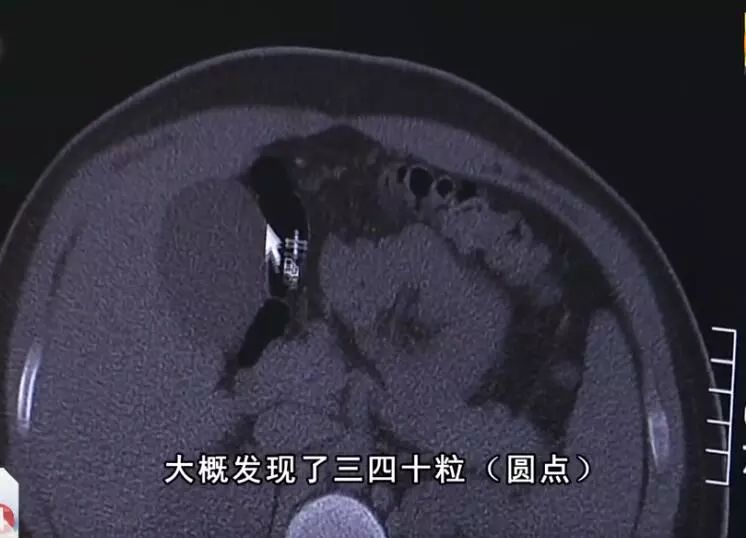 13岁男孩喝珍珠奶茶引发的案例,13岁男孩喝珍珠奶茶后肠梗阻