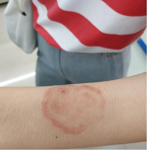 体癣的最佳治法,治疗体癣最好的小妙方