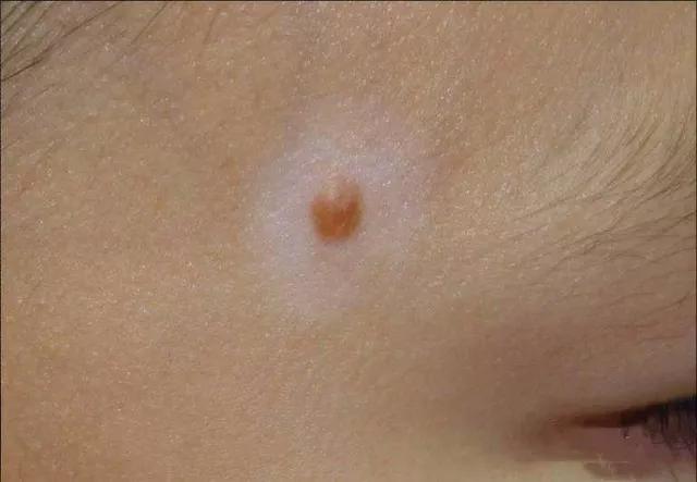 邯郸中药调理白癜风中医诊所,邯郸一院能治白癜风吗