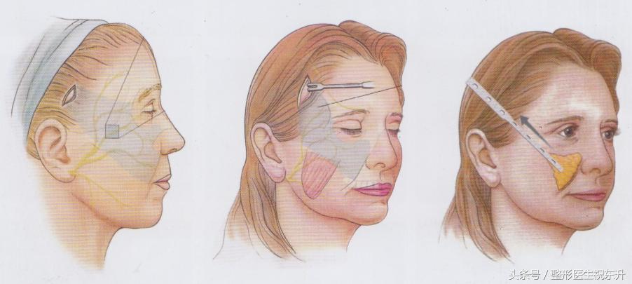 浅谈面部五层提升为什么能更好的解决面部松弛下垂