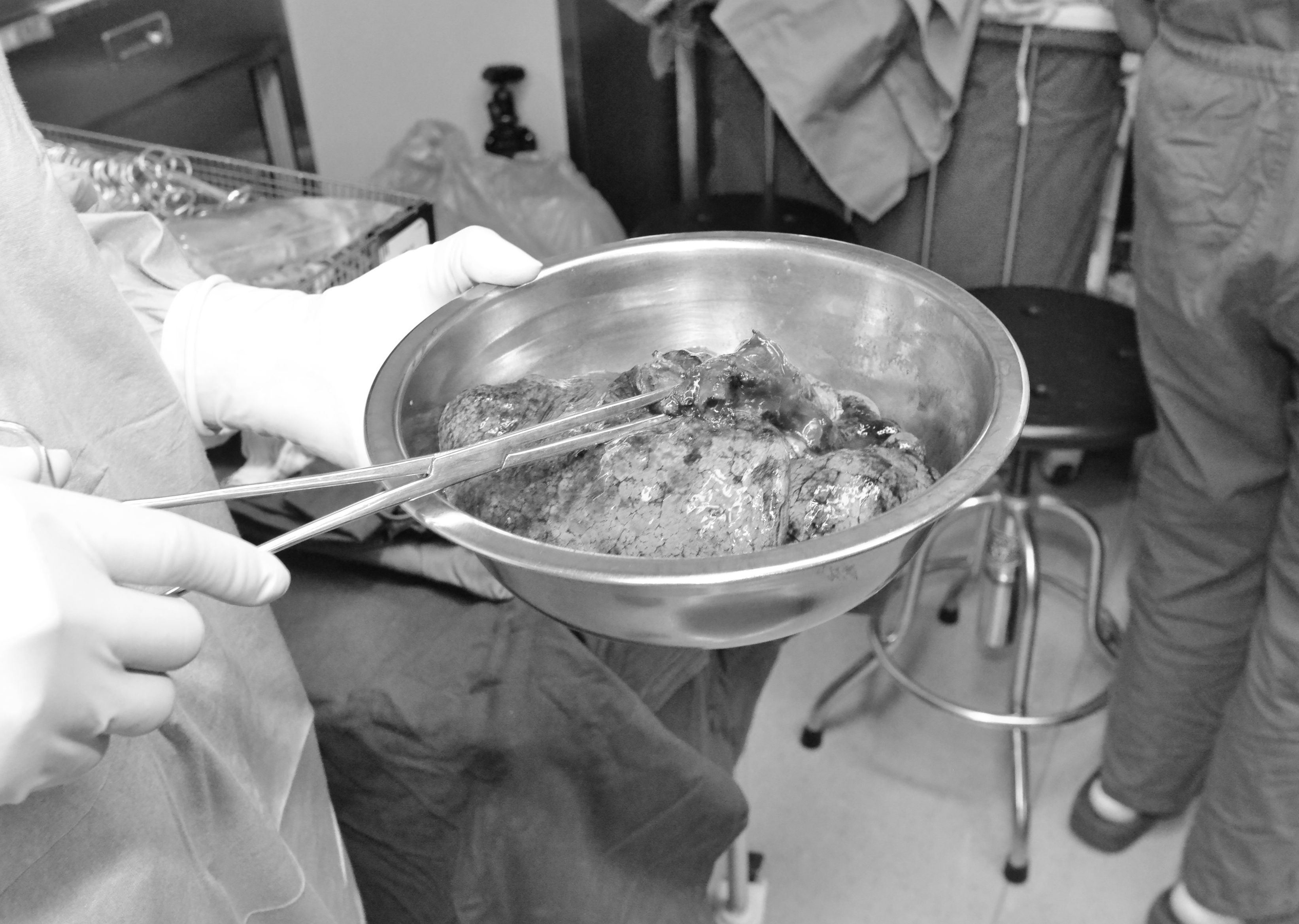 黑龙江首例人工心脏成功植入,全球首例全胸腔双肺移植完成