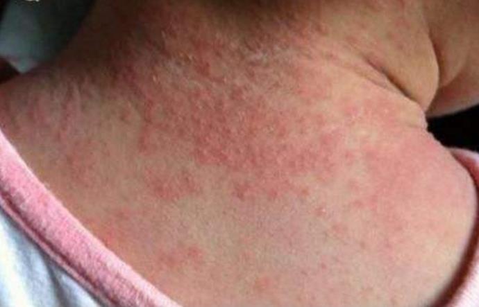 宝宝长痱子了要怎么办,宝宝已经起痱子了怎么办