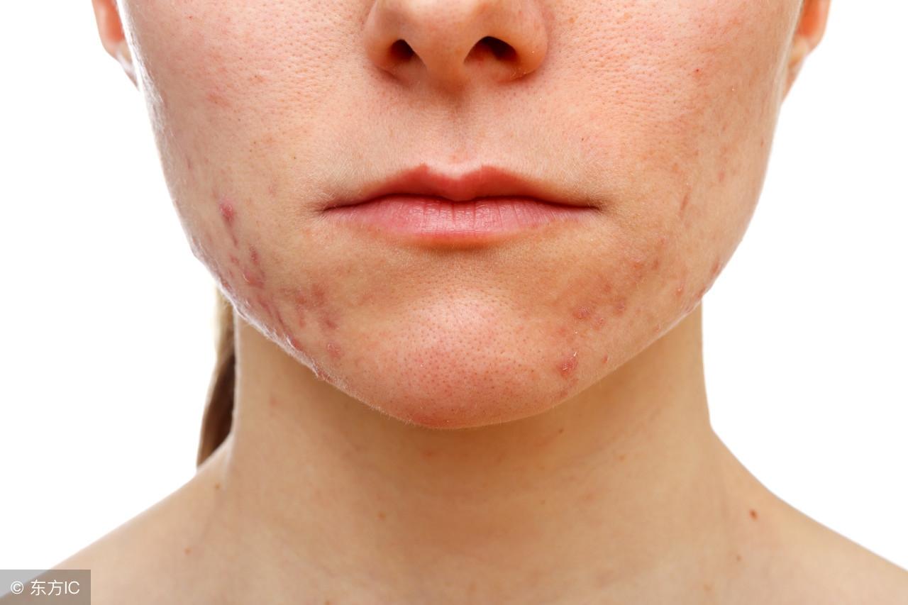 闭口粉刺痘痘肌怎么改善,毛孔粗大黑头粉刺闭口护肤品医美