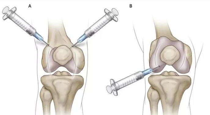 膝盖疼能不能打封闭,膝盖封闭要打几次才管用