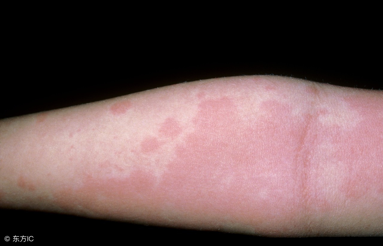 皮肤麻疹的症状和注意事项,皮肤风团荨麻疹怎么治