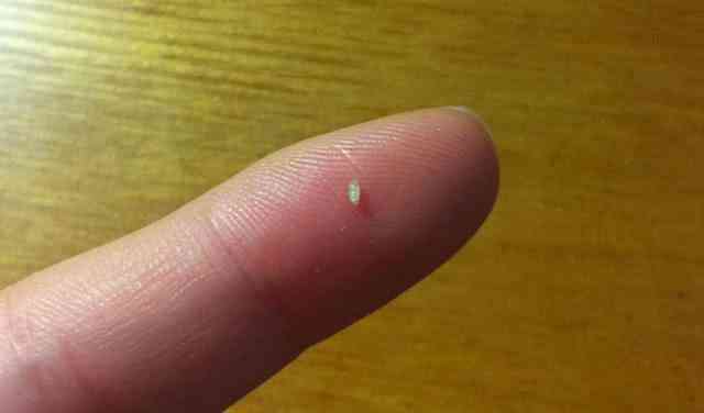 脸上有白米粒该用什么产品,脸上抠出来白色的东西是什么