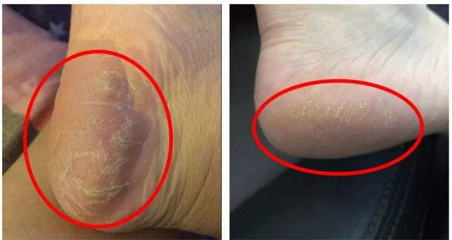 怎样能够有效去除脚上死皮,脚上死皮不处理会怎么样