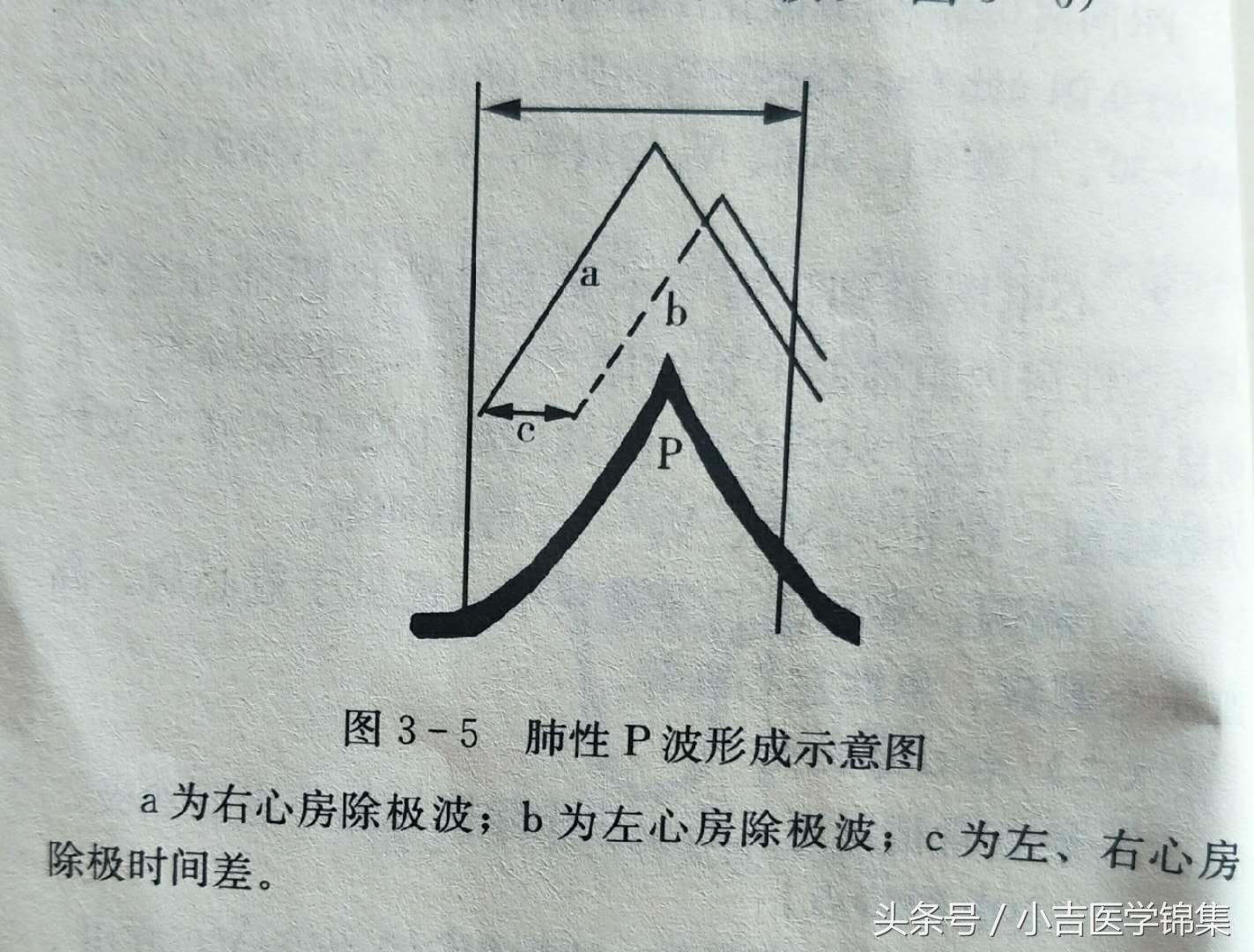 心房心室肥大,房室肥大要紧吗