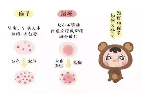 宝宝湿疹和痱子可不一样,这个方法学会了,对付湿疹最好了!