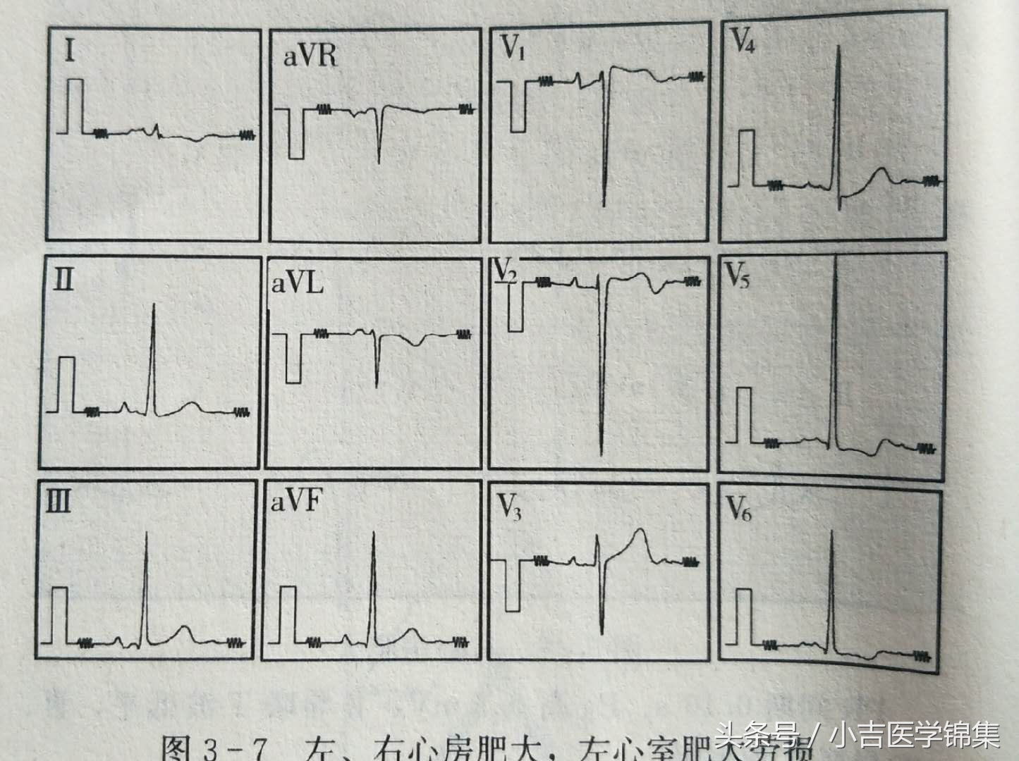 心房心室肥大,房室肥大要紧吗