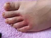 告别“香港脚”，需要用马油！一天涂抹一次，保证24小时清爽！