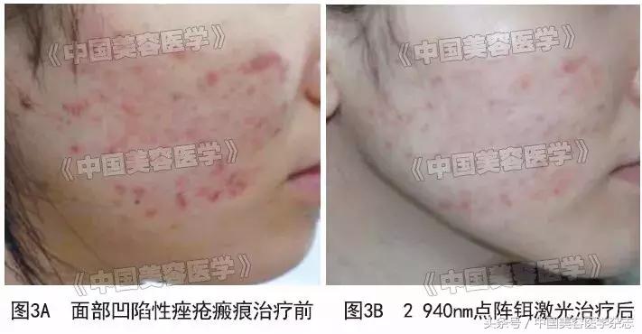 点阵激光打凹陷性疤痕,点阵激光治疗瘢痕疙瘩的效果