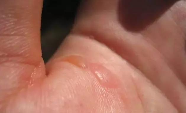 在家身上被开水烫伤后怎么急救,儿童开水烫伤急救处理