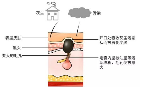 用了泥膜黑头祛不掉,黑头去不去除
