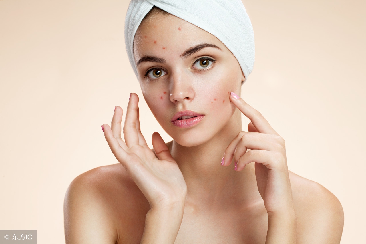 祛斑各种斑的专业知识,号称斑中之王的黄褐斑之祛斑攻略