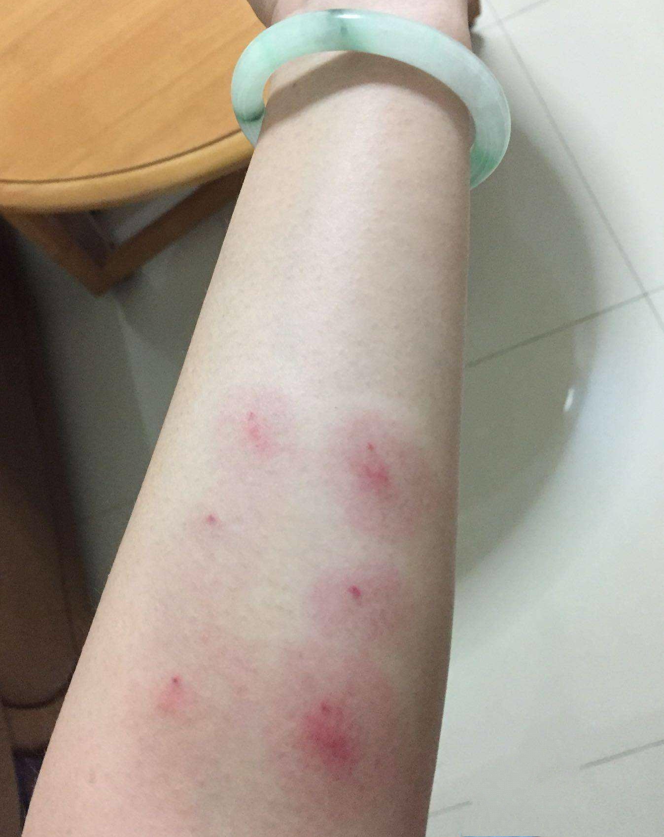 如何查询是封闭抗体导致的流产,反复流产封闭抗体治疗怎么停了