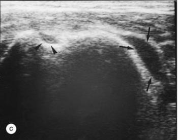 老年不明原因发热,老年人无症状发烧是怎么回事